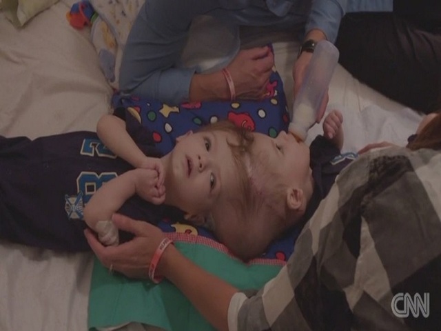 Separated twins move to rehab after emotional hospital farewell