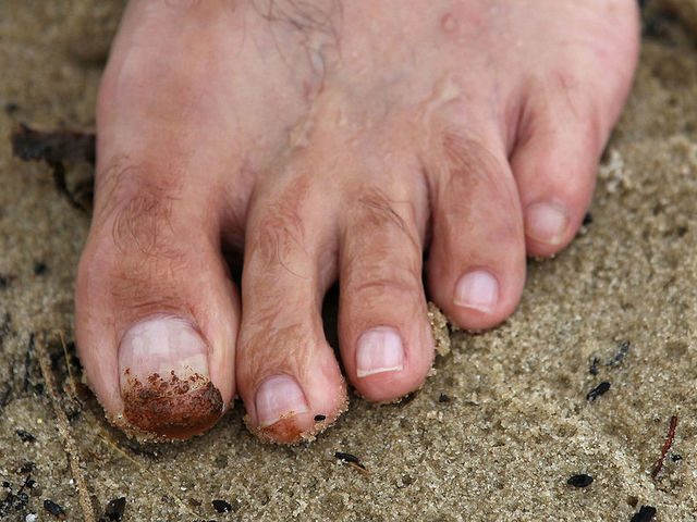 Human toe stolen from Canadian bar